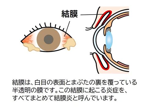 慢性結膜炎|慢性結膜炎とは 